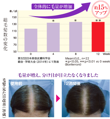 総毛髪数の変化 全体的に毛量が増加 約15%アップ　毛髪・見た目改善（58歳） 毛量が増え、分け目が目立たなくなりました